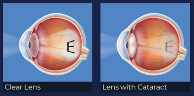 Clear lens versus lens with cataract