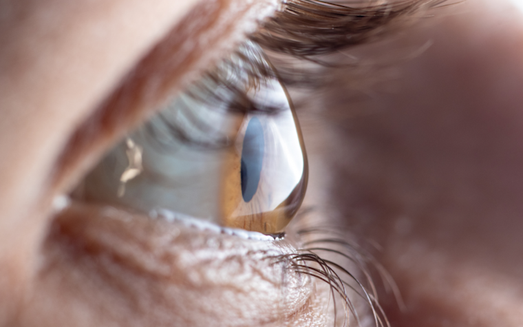 What is Astigmatism?