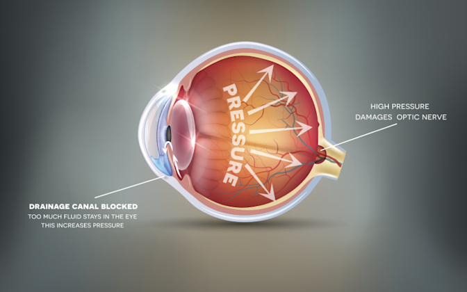 glaucoma Image